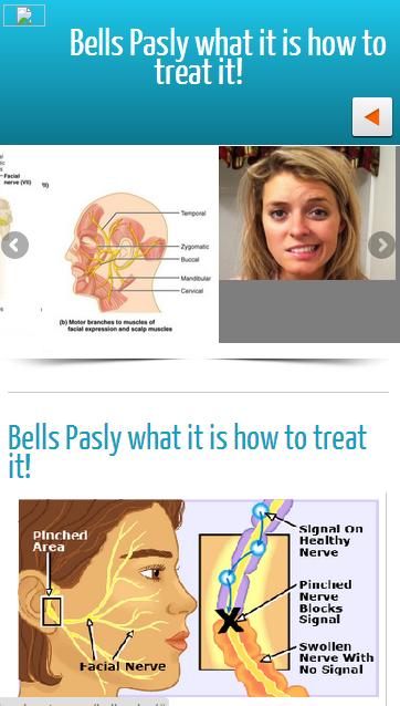 Bells Palsy