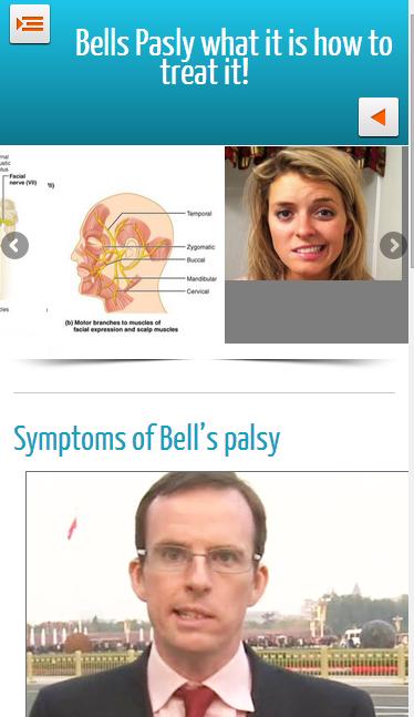 Bells Palsy